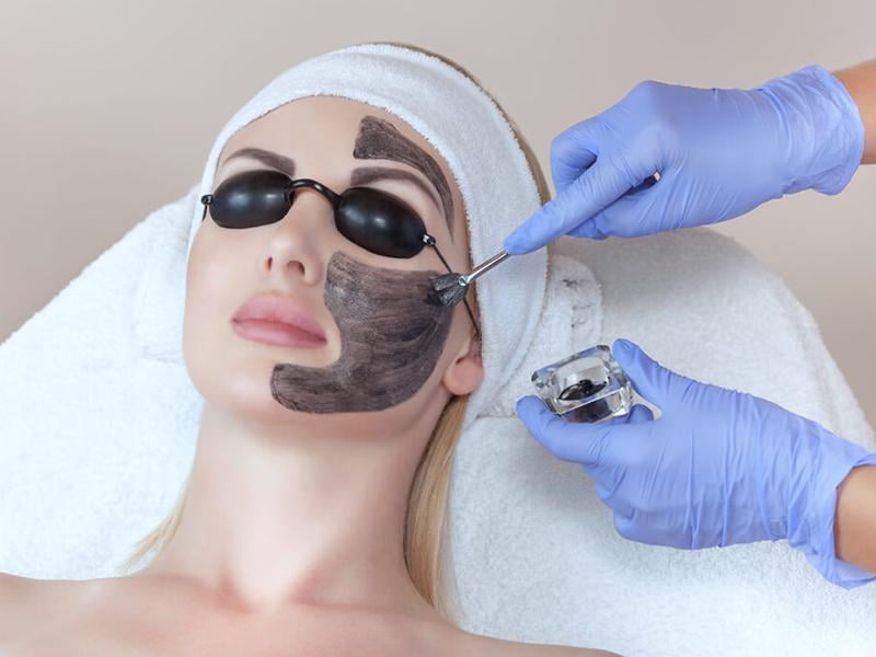 Carbon Laser Peel